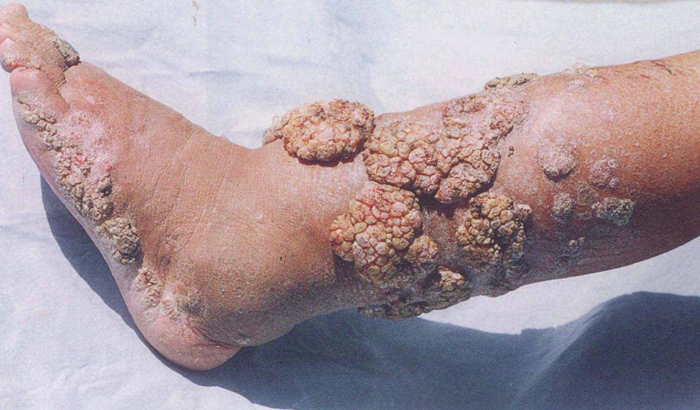 芽生菌病樣膿皮病